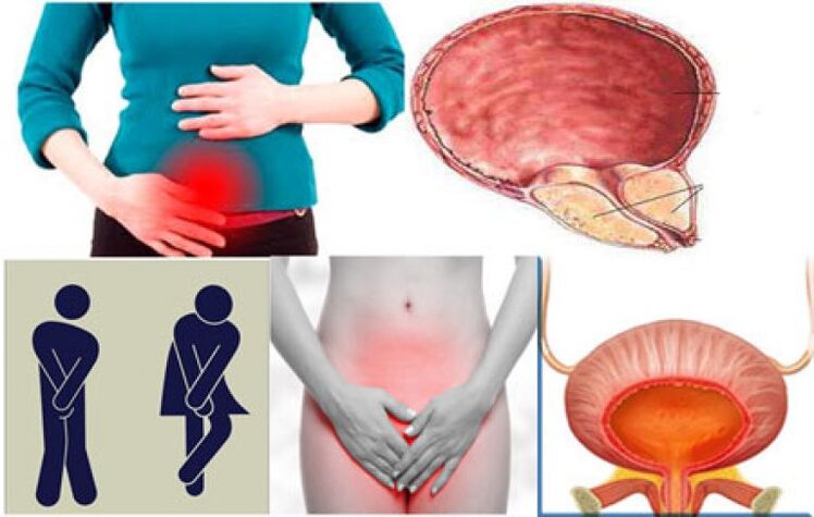 Signs of cystitis in women - burning and pain when urinating
